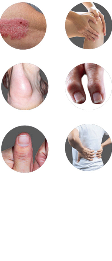 Nail Psoriasis vs. Nail Fungus: Photos and 5 Differences | MyPsoriasisTeam